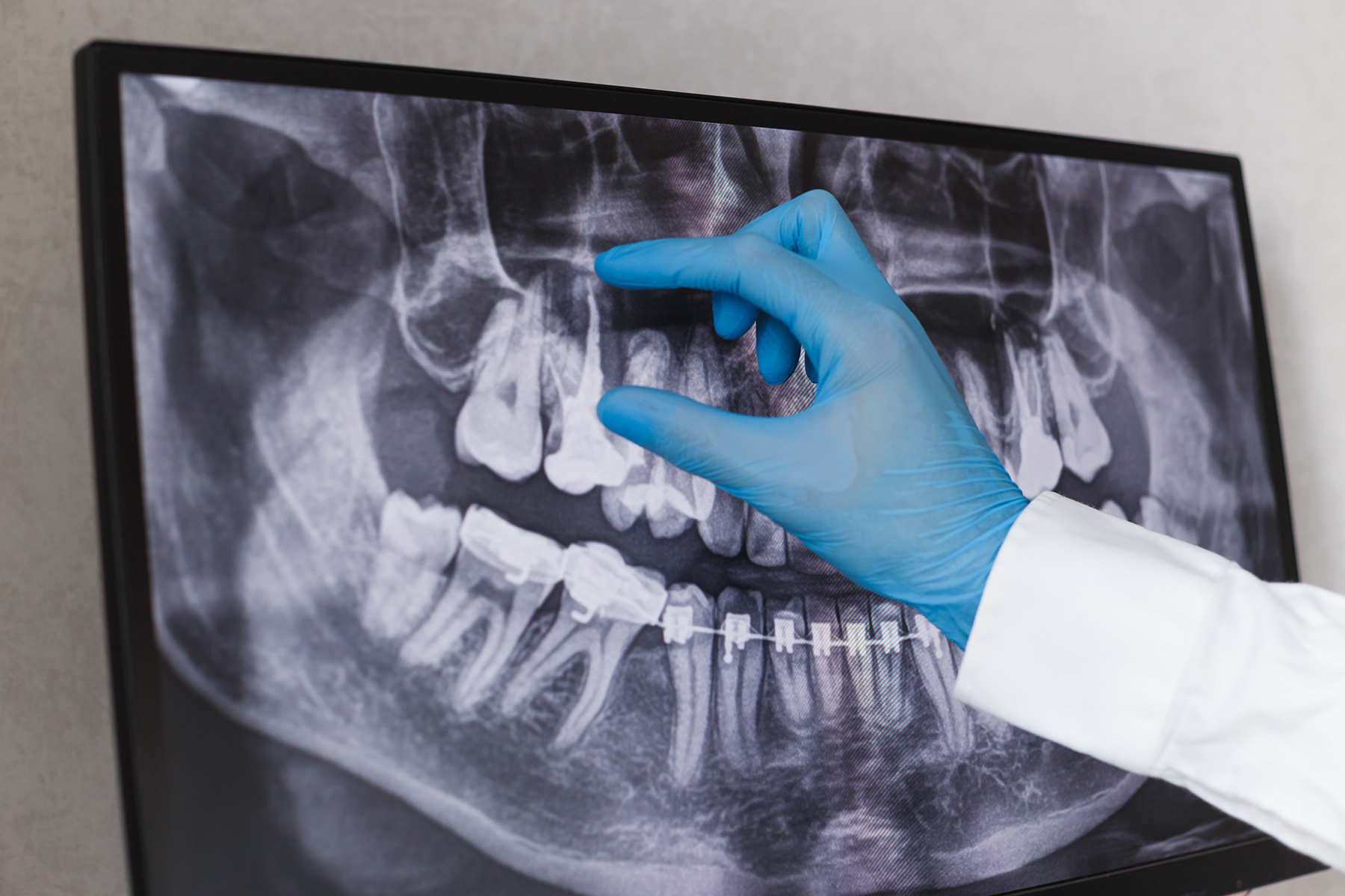 Root canal treatment in Canton, OH