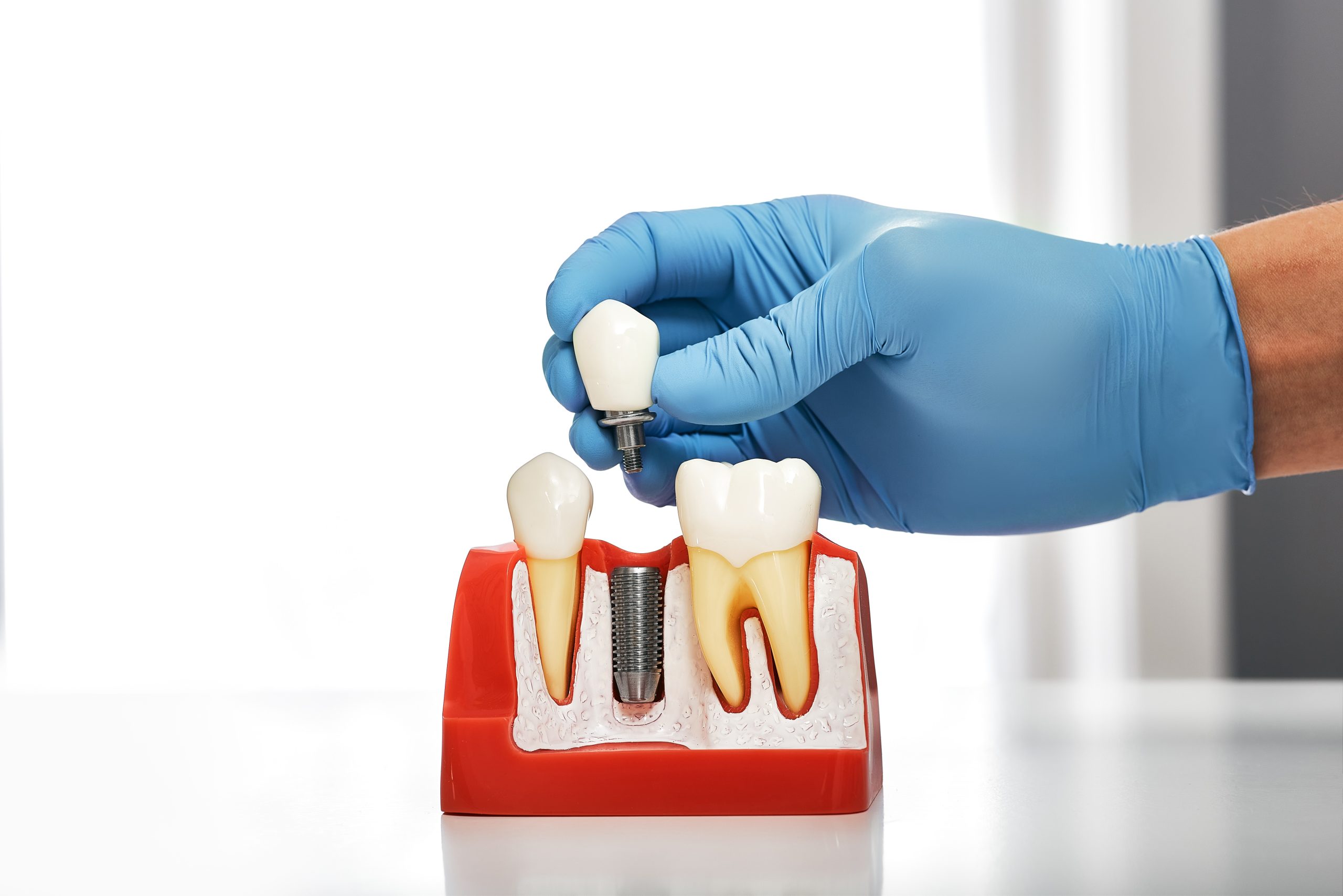 Implant Dentist in Canton, OH